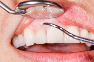 gum disease schaumburg il